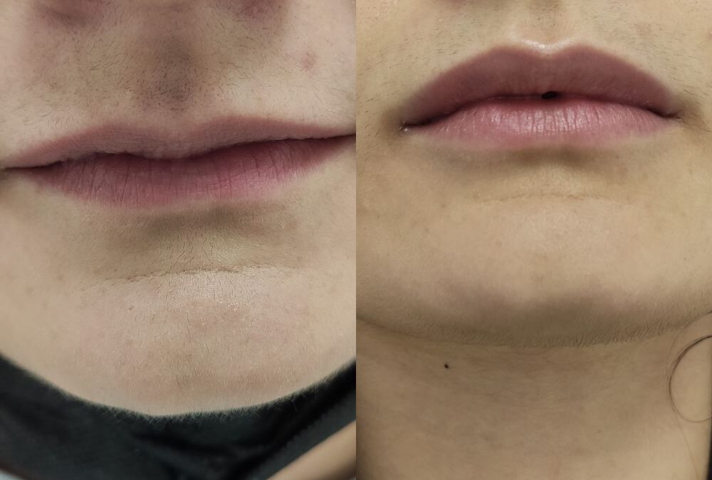 AUMENTO DE LABIOS